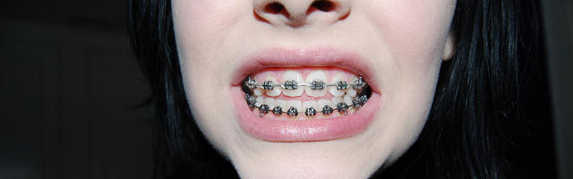 Fogszabályozás foghúzással