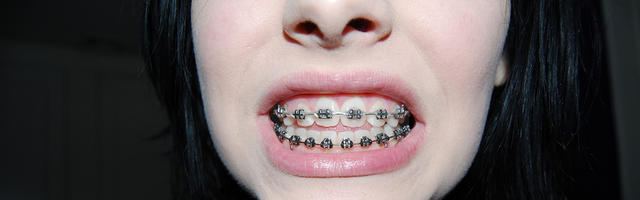 Élet fogszabályzóval