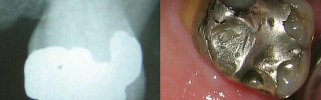 Amalgám tömés káros hatásai