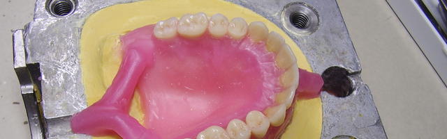 Műfogsor - Hogyan és miből készülnek a fogpótlások?