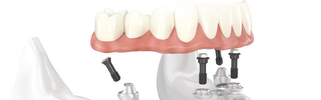 Kezelés előtti tudnivalók: All-on-4® (Same-day teeth)