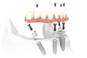 Kezelés előtti tudnivalók: All-on-4® (Same-day teeth)