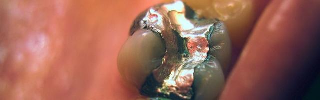 Amalgám vagy kompozit?