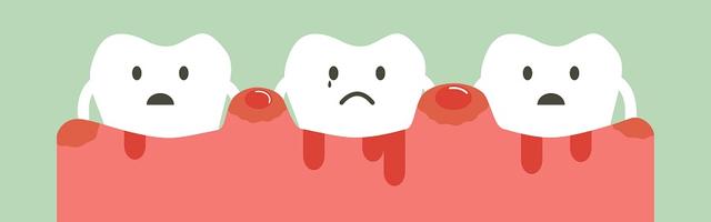 Ínygyulladás kezelése otthon? Lehetséges!