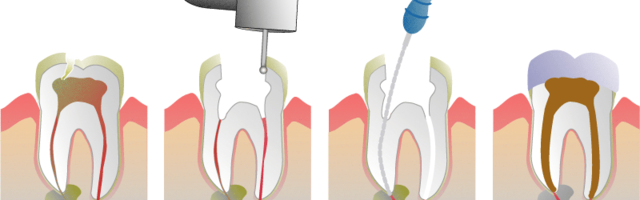 Tévhitek a gyökérkezelésről