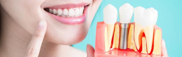 5 kérdés és válasz a fogászati implantátumokról