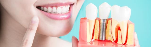 Fog implantátum - Hogyan és miből készülnek a fogpótlások?
