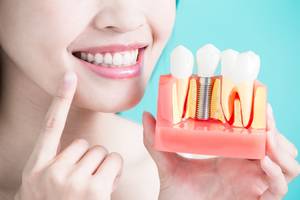 5 kérdés és válasz a fogászati implantátumokról