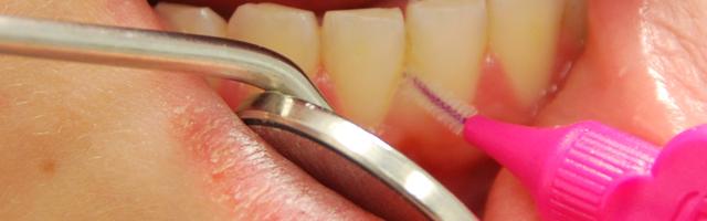 Fogtisztító eszközök - Az interdentális fogkefe