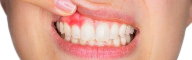 Ínygyulladás kezelése