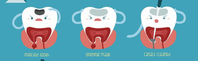 Mikor kell gyökérkezelni és miért?