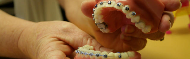 Fogszabályozás foghúzás nélkül