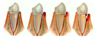 ejemplo-periodontitis