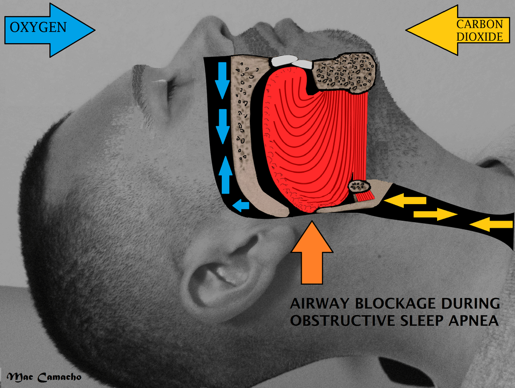 sleep apnea